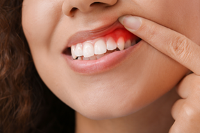 Treating Gum Disease