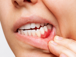 Treating Gum Disease
