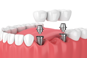 dental implant