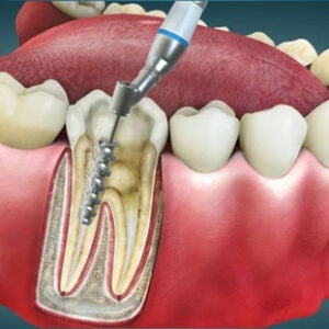 Illustration of a dental procedure showing a root canal treatment with a rotary file cleaning the inside of a tooth.