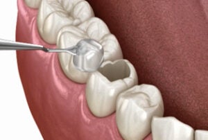 Illustration of a dental procedure showing placement of an inlay or onlay filling into a prepared molar cavity.