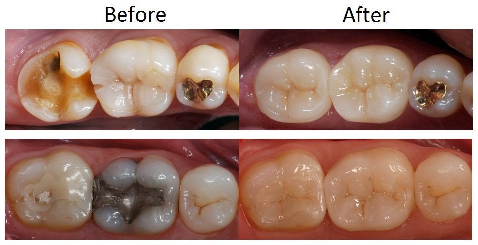 Dental Crowns in Schaumburg 