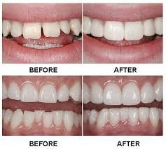 Cosmetic Dentistry in Glendale Heights 