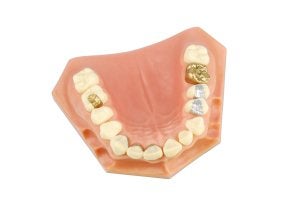 dental veneer schaumburg il