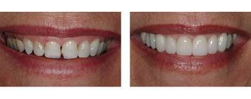 Veneers in Schaumburg